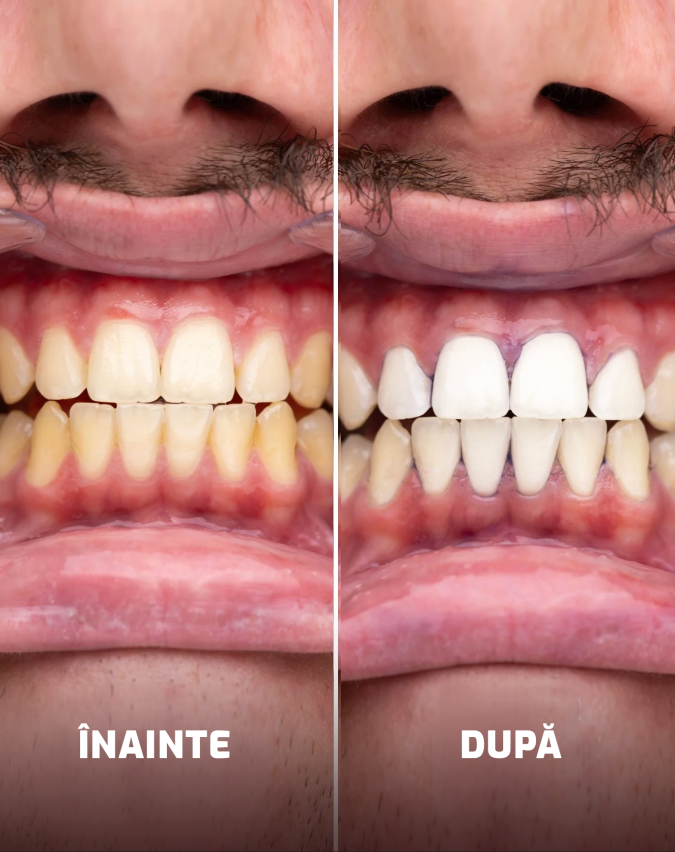 Set Benzi de albire + Pastă de albire a dinților